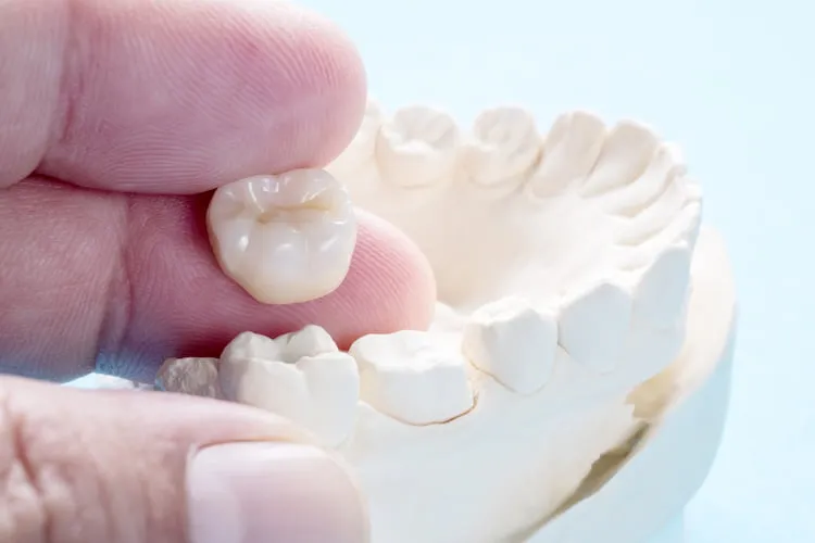 A finished ceramic crown held up beside a dental model